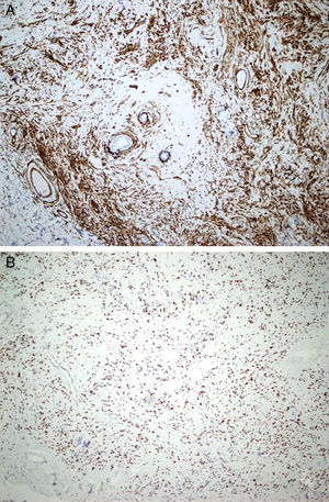 A, Diffuse immunohistochemical staining of tumor cells for CD34 (CD34, original magnification ×200). B, Nuclear staining of Stat 6 (Stat 6, original magnification ×200).