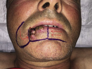 Tumor and planned incision mark.