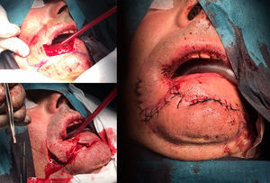 Surgical steps from start to closure.