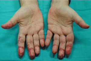 Ulcers on the palms and palmar surfaces of fingers in the first patient.