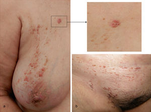 A, Multiple erythematous papules on the right chest and breast were distributed along Blaschko lines. The supramammary plaque (enlargement, upper right figure) had a pearly surface with telangiectases and globules. B, Papules and comedones in the right pubic area and groin.