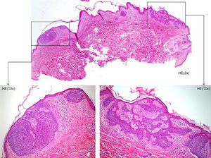 Nests of basaloid cells among focal areas where strands of basaloid cells proliferate with pilar differentiation, scant mitotic activity, and a loose stroma. Hematoxylin-eosin.