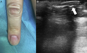 A, Normal clinical examination. B, B-mode ultrasound shows a well-defined, solid hypoechoic lesion with an oval form and regular borders measuring 3.1mm in diameter.