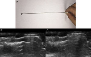 A, Homemade metallic ultrasound guide. B and C, Use of comet tale reverberation to create an ultrasound guide for preoperative localization.