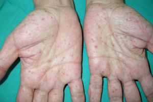 Palmar pits in a patient with Gorlin syndrome.