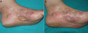 A, Cutaneous ulcer on the medial aspect of the left foot against a background of livedo racemosa and retiform purpura. B, Atrophie blanche due to scarring following the use of oral rivaroxaban.