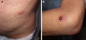 Clinical presentation. A, Painless erythematous nonfluctuant nodule on the left abdominal flank. B, Pustule containing blood-stained pus with a fluid level on an indurated erythematous base.