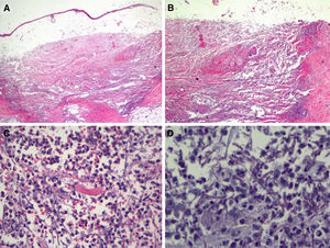 Histologic features of the pustule following incisional biopsy. A, Large subepidermal blister with major underlying tissue destruction affecting the entire dermis and subcutaneous tissue (hematoxylin-eosin staining, original magnification ×20). B, Dense neutrophilic infiltration with destruction of dermal collagen and associated vasculitis (hematoxylin-eosin original magnification ×100). C, Detail showing dense neutrophil infiltration in the dermis and around barely perceivable filamentous structures (hematoxylin-eosin, original magnification ×200). D, Higher magnification and periodic acid-Schiff (PAS) staining showing septate linear structures with acute-angle branching consistent with the clinical and microbiologic diagnosis of cutaneous aspergillosis (PAS ×40, original magnification ×400).