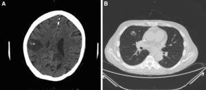 Radiologic study after 3 days. A, Cranial computed tomography (CT) scan showing a nonvascular lesion in the right parasagittal-parietal region with internal spots of bleeding and a considerable intracranial mass consistent with cerebritis (*). B, CT scan of the chest area showing a cavitated nodule in the anterior segment of the right upper lobe, consistent with aspergilloma (+).
