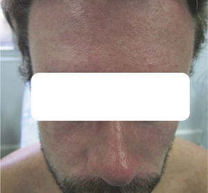 Confluent erythematous papules on the forehead, the dorsum of the nose, and both cheeks 24hours after initial appearance.