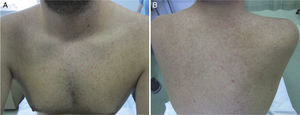 A, Papular erythematous rash on the chest. B, Papular erythematous rash on the back.
