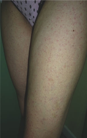 Detail of the papular erythematous lesions on the extensor surface of both thighs.