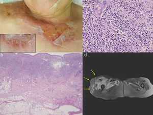 Bullous Sweet's syndrome with myositis | Actas Dermo-Sifiliográficas
