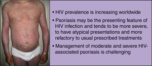 HIV-associated psoriasis.