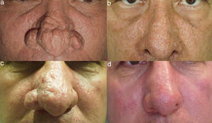 Electrosurgery for the Treatment of Moderate or Severe Rhinophyma ...