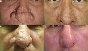 A, Patient 1, a 56-year-old man with severe rhinophyma. B, Excellent results 2 years after the procedure. Note the persistence of dilated pores and the absence of pigmentary alterations in this patient with skin phototype iv. C, Patient 5, a 50-year-old man previously treated with isotretinoin and carbon dioxide laser. D, Significant improvement in hyperplasia on the right ala nasi and nasal tip 20 weeks after electrosurgical treatment.