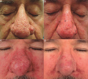 A, Patient 6, a 60-year-old man with severe rhinophyma. B, Good clinical response 2 weeks after electrosurgical treatment. Note the mild postsurgical erythema. C, Patient 7, a 56-year-old man with severe rhinophyma previously treated with isotretinoin. D, Surgical response with good scarring 12 weeks after the procedure.