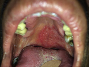 Rounded ulcer 2cm in diameter on the soft palate. The ulcer has well defined borders and a granulomatous base.