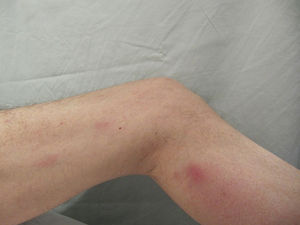 Multiple painful erythematous nodules 1cm in diameter located on the lower limbs.