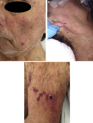 Multiple rounded purpuric papules with central umbilication, ranging in size from 2mm to 4mm, located on the face (A and B) and the limbs (C).