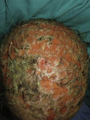 De-epithelialized alopecic plaques with a scar-like appearance throughout the scalp, alternating with purulent and macerated areas.