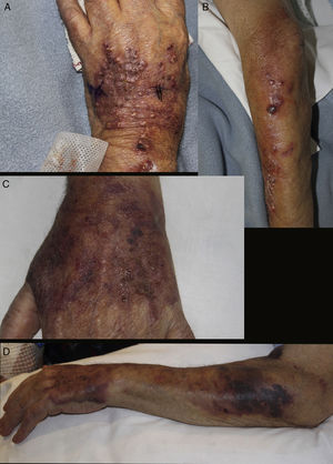 A and B, Well-defined infiltrated erythematous-violaceous plaque on the dorsum of the hand, with pustular and crusted lesions on the surface. Nodular and ulcerated lesions distributed in a sporotrichoid fashion on the forearm. C and D, Lesions resolving in the form of purpuric macules and crusted debris on the dorsum of the hand and forearm.