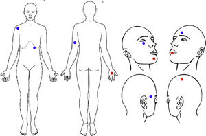 Location of skin cancer in study patients treated with NB UV-B phototherapy. Basal cell carcinoma is shown in blue and squamous cell carcinoma in red.