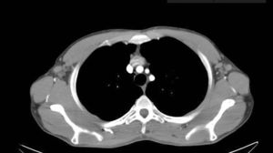 Patient 4. Computed tomography scan of chest and abdomen: enlarged bilateral axillary lymph nodes with a diameter of up to 13.7mm at the narrowest point on both sides.