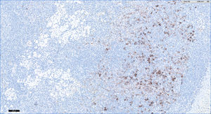 Patient 4 (CD1A×10), original magnification. Note the paracortical hyperplasia composed of Langerhans cells.