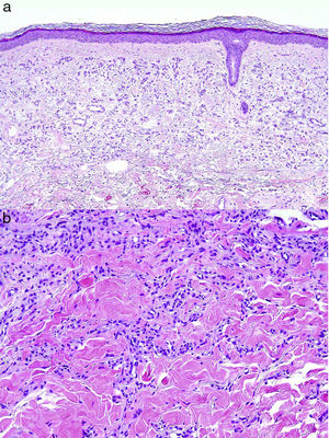 A, Proliferation of small vessels with inconspicuous lumina in the reticular dermis in the biopsy of the first patient (hematoxylin-eosin X10). B, Image of increased amplification showing the fine wall vessels without signs of atypia in the third patient (hematoxylin-eosin X20).