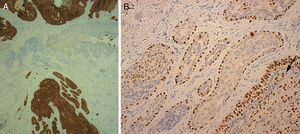 A, Cytokeratin 7 staining with positive results for tumor cells and negative results in the epidermis (original magnification ×40). B, p63 positivity in peripheral myoepithelial cells in the benign area and in malignant cells infiltrating the tubular structures (arrow) (original magnification ×200).