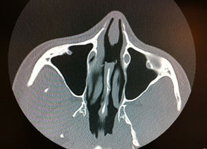 Computed tomography scan showing perforation of the nasal septum but no other alterations.