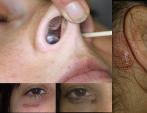 Perforation of nasal septum and excoriations in the right orbital and retroauricular areas.