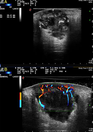 A, Heterogeneous polylobulated solid-cystic lesion in the dermis and extending into the subcutaneous tissue, coinciding with the histologic image; note the sparing of the superficial area of the dermis. B, Power Doppler imaging showing abundant peripheral vascularity penetrating the lesion from several poles.