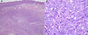 Infiltration of the dermis by a proliferation of cells forming solid nests of cells (A) (hematoxylin-eosin, original magnification ×4) with a squamous growth pattern and marked nuclear pleomorphism, prominent nucleoli, and several mitotic figures (B) (hematoxylin-eosin, original magnification ×400).