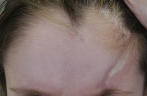 Five-year-old boy with mixed morphea (circumscribed-linear ECDS) as defined by the PReS classification. The linear component can be seen in the lesion on the left side of the forehead.