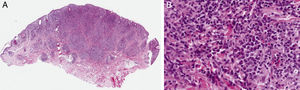 A, hematoxylin–eosin, original magnification ×10. B, hematoxylin-eosin, original magnification ×40.