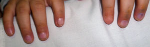 Patient #2. Unilateral involvement of the left index finger with micronychia on the ulnar and radial sides of the nail bed. The rest of the nails are unaltered.
