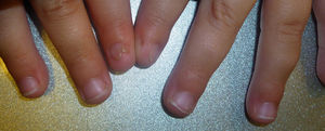 Patient #3. Polyonychia of the left index finger and nail dystrophy of the right index finger.