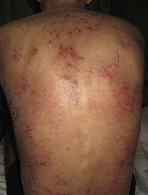 Severe atopic dermatitis. Note the multiple erosions, excoriated papules, and marked xerosis on the back.