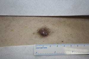 Erythematous-violaceous lesion (2cm) with a firm consistency on the lower back.