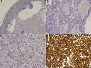 Histopathology. A,Well-defined, nonencapsulated dermal-hypodermal lesion with solid cystic areas (hematoxylin-eosin, original magnification ×10). B and C,Two types of cell can be distinguished in the solid portion of the tumor. Polyhedral cells, with a long vesicular nucleus and eosinophilic cytoplasm (B), and large cells with an eccentric nucleus and abundant clear cytoplasm (C) (hematoxylin-eosin, original magnification, ×20 and ×40). D)Positive immunohistochemistry result for CK-7 (CK-7, ×40).