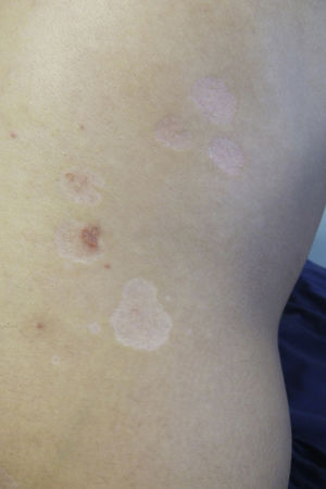 Slightly depressed hypopigmented and pink plaques of various sizes on the patient's back. Mild desquamation can be observed on some.
