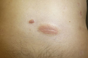 Psoriatic plaques in the center of depressed areas.
