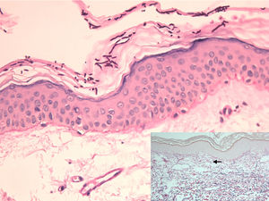 Epidermis with abundant hyphae and spores in the stratum corneum and flattening of the rete ridges (periodic acid–Schiff, original magnification ×200). The inset shows diminished fine elastic fibers in the papillary dermis (arrow) and fragmented elastic fibers in the superficial reticular dermis, as well as vascular ectasia (orcein stain, original magnification ×100).