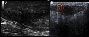 A, B mode, 18-MHz probe. The presence of a fistulous tract in the subcutaneous cellular tissue and a fluid collection area can be observed. B, Doppler study showing intense vascularization inside the fistulous tract.