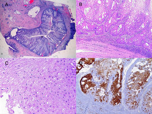 A, Well-differentiated squamous cell carcinoma covering the fistulous tract. B, Expansive growth pattern of squamous cell carcinoma in greater detail. C, Areas with a koilocytic appearance. D, Extensive nuclear and cytoplasmic positivity to p16.