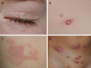 Different clinical manifestations of molluscum contagiosum (MC). A, Pink papules on the eyelids with typical central umbilication. B, Sessile lesion of less typical morphology next to other lesions more characteristic of MC. C, Eczematiform reaction (molluscum dermatitis) surrounding MC lesions. D, Inflamed and abscessed lesions on the abdomen.