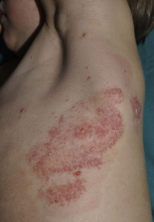 Purpuric reaction to topical application of EMLA (eutectic mixture of local anesthetics) cream and occlusion for 1 hour.