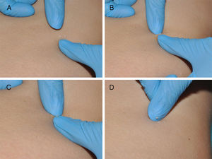 Manual expression of molluscum bodies with the fingers. A, The lesion is squeezed between 2 fingers. B and C, A whitish molluscum body is extruded. C, Tissue damage is minimal.